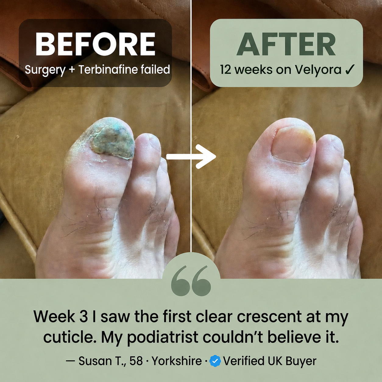 Velyora™ Oregano & Black Seed Oil — If Terbinafine Didn't Hold, This Is Why